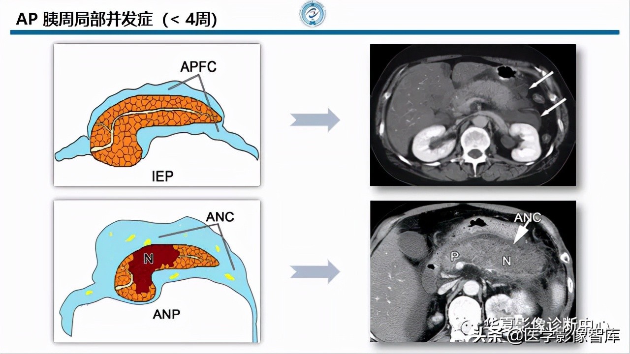 核磁ct都显示急性胰腺炎,急性坏死性胰腺炎的ct表现