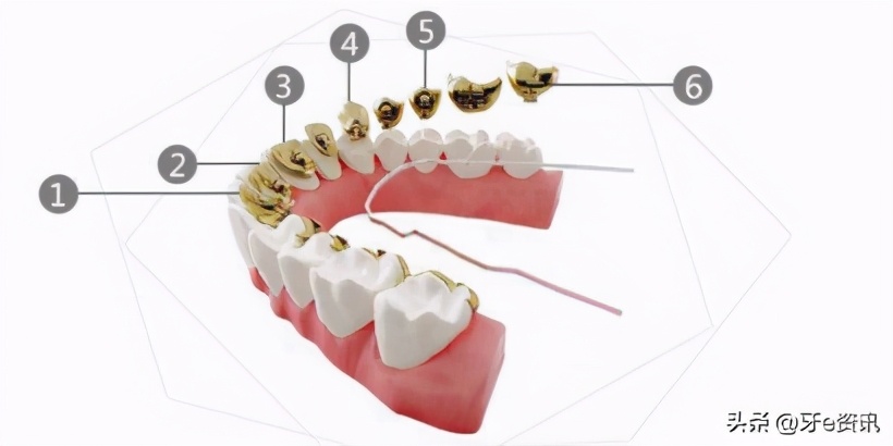 牙e资讯每日播报：3M发布黄金牙套，低调炫富于无形