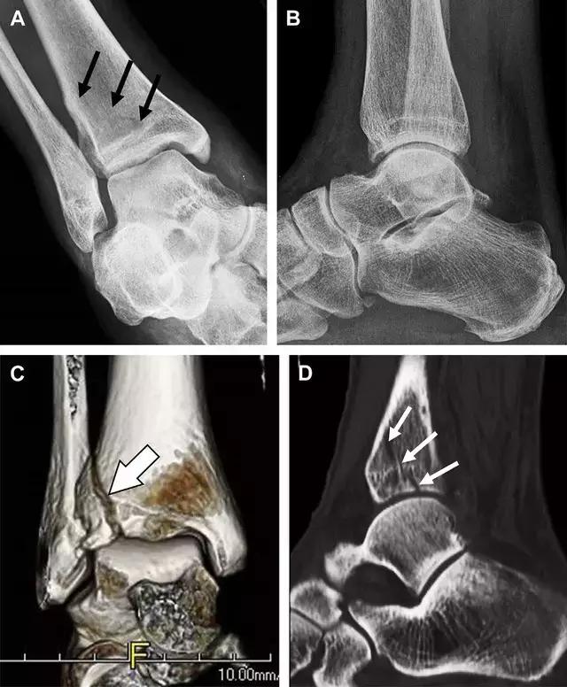 放射科夜班病例大全,放射科容易漏诊的骨折