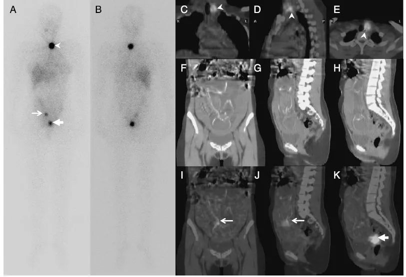 甲癌碘131后甲状腺肿大,甲状腺显像后发现怀孕
