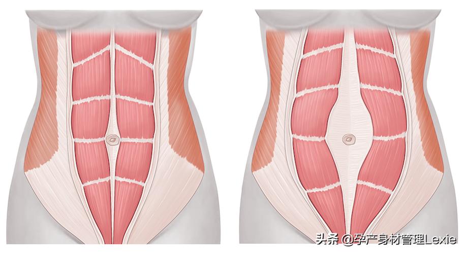 产后腹部肌肉分离怎么恢复,产后怎么恢复大腿内侧肌肉