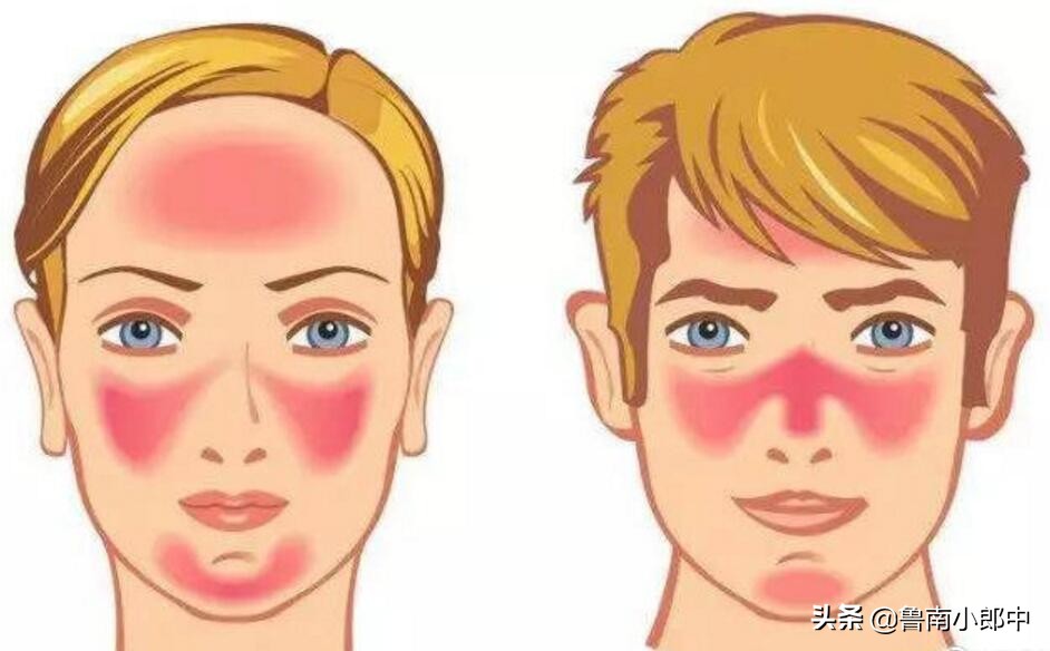 干燥泛红过敏了怎么办,脸上干燥起皮泛红痒是怎么回事