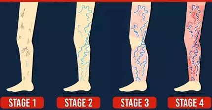 腿上有蚯蚓纹怎么回事,腿上出现蚯蚓似的纹路是怎么回事