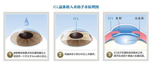 近视1000度以上可以做近视手术吗,近视200多度可以做近视手术吗