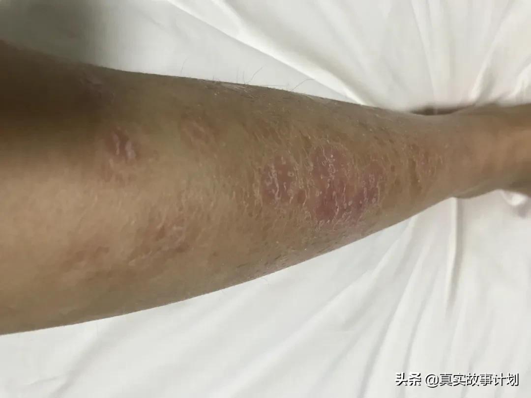 故事：暂别银屑病后，她想为自己拍一组裸照