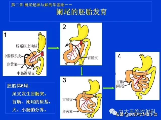 阑尾炎课件,阑尾炎的超声课件