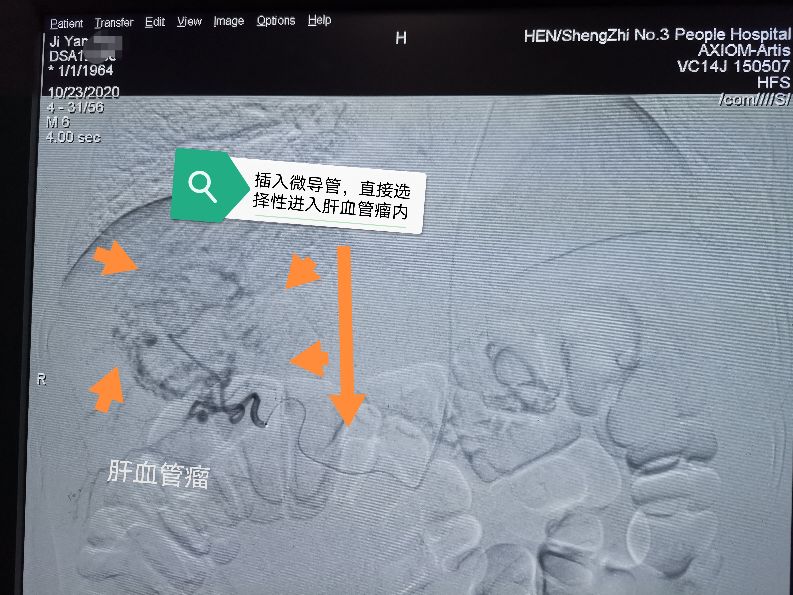 肝血管瘤10公分了介入治疗可以吗,介入治疗肝血管瘤是最好的方案吗