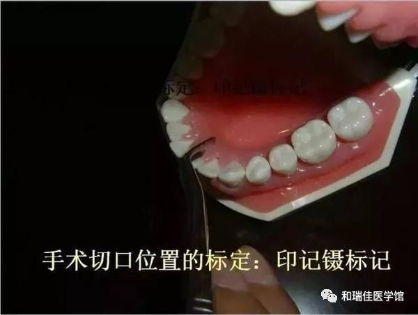 松牙固定需要什么条件,钢丝松牙固定操作流程