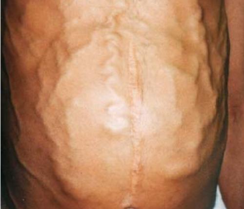 肝不好出现2痒3黑,肝不好的人会出现一痒二痛三黄