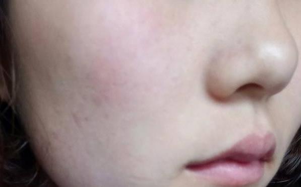 皮肤敏感泛红角质层受损如何修复,改善皮肤泛红敏感肌
