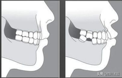 缺牙后果严重吗,缺牙的危害视频全过程