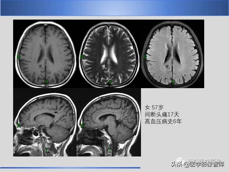 vr间隙概念,vr间隙需要做什么检查
