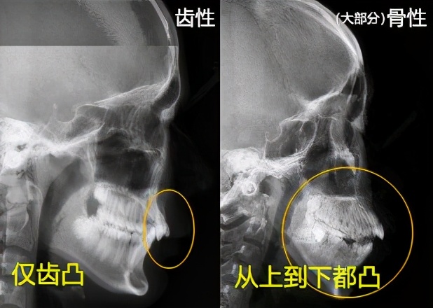 突嘴正颌手术有哪些风险,正颌手术凸嘴3d动画演示