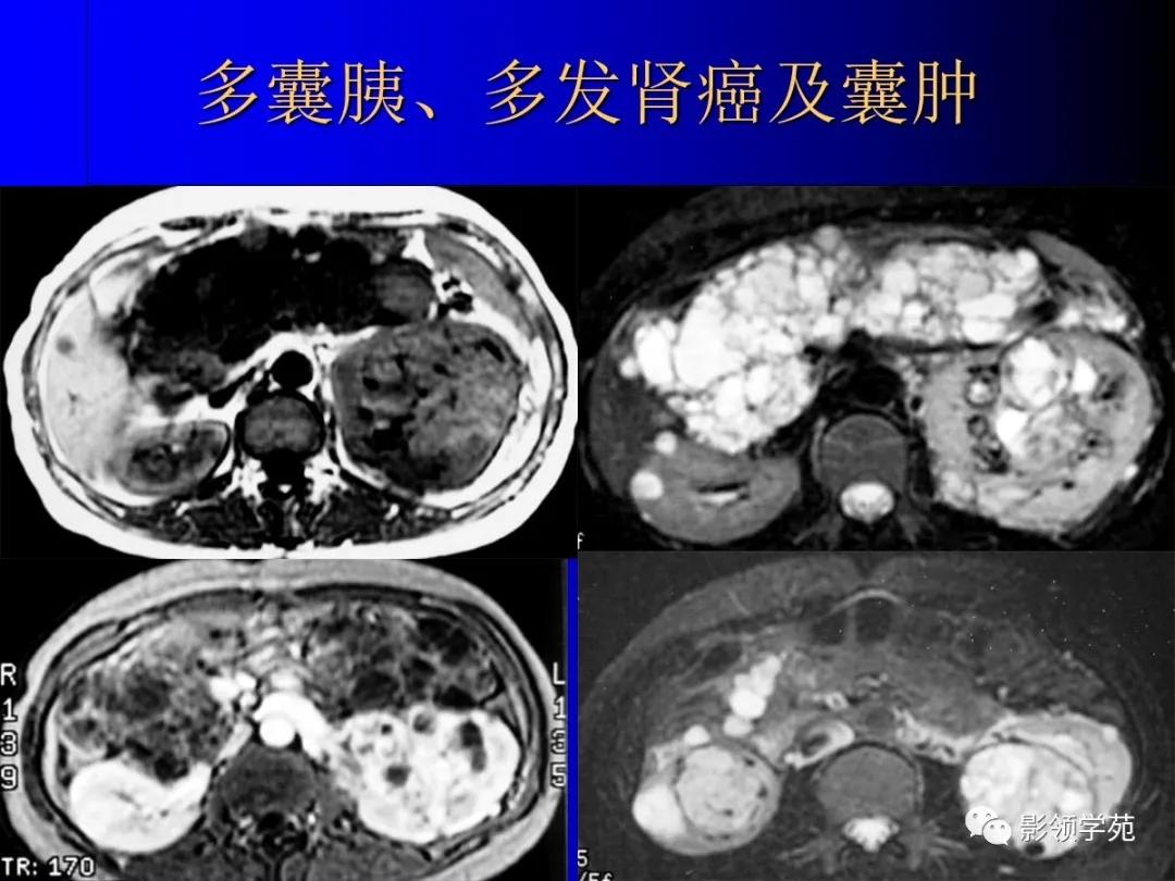 肾脏囊性肿块的影像学特点,肾脏典型病理图片及解析