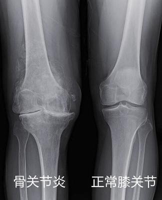 膝盖疼、老寒腿、长骨刺，关节炎了怎么办？45个短问，彻底讲清