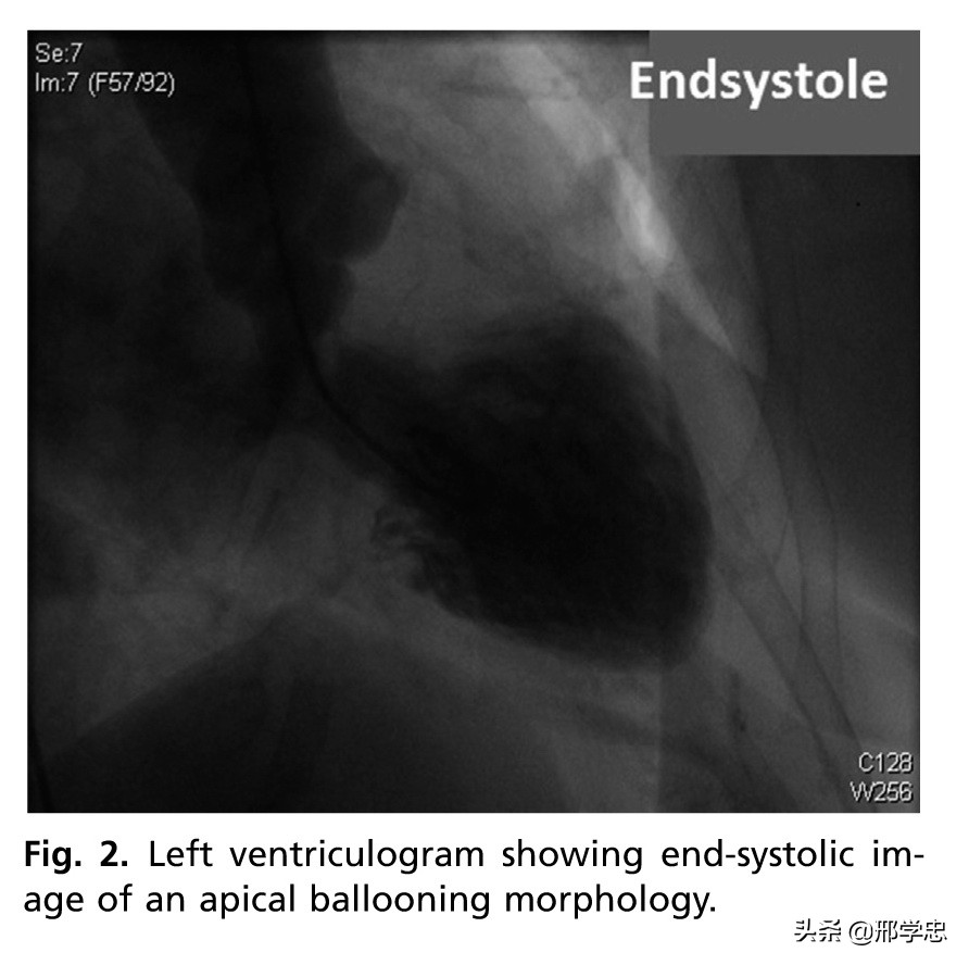 应激性心肌病搭桥,应激性心肌病反复