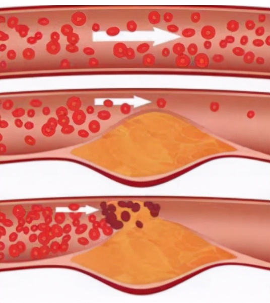 脑动脉硬化不及时治疗有什么后果,脑动脉硬化有7个征兆怎么治疗