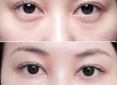 眼容易肿有黑眼圈,黑眼圈肿眼泡有什么小妙招