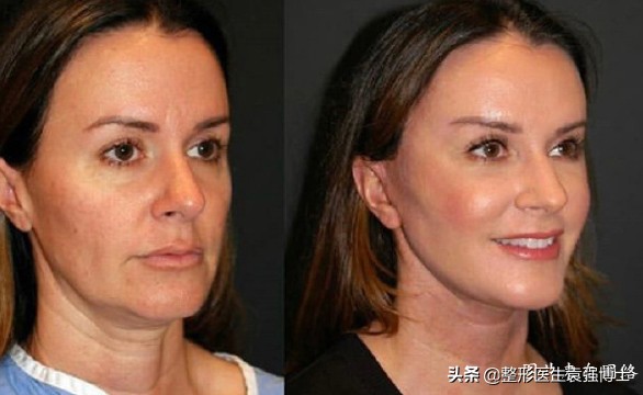 额头拉皮手术能维持几年,耳部小拉皮手术能维持几年