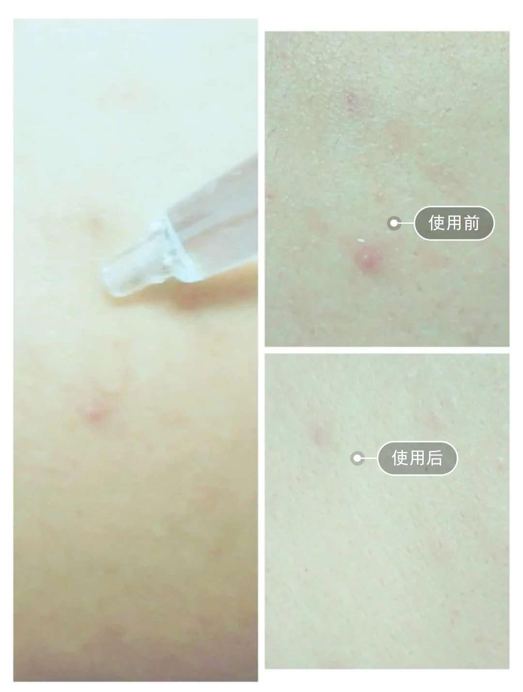 丽普司肽对痘痘好用吗,丽普司肽冻干粉成分表