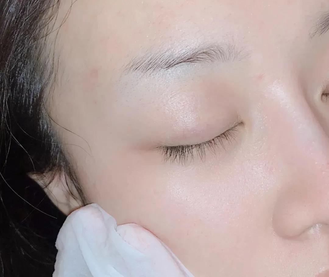 甲硝唑凝胶的使用方法祛黑头,祛黑头最好的方法目前最有效