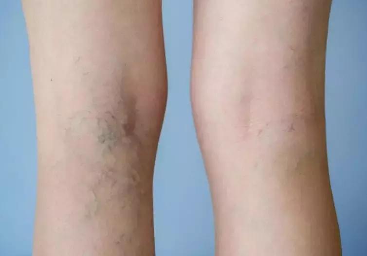 腿上的血管像蚯蚓是什么原因,腿上的青筋像网状太明显了