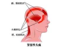 生活压力大导致头痛用什么最好,压力紧张性头痛