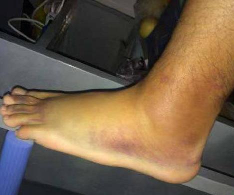 肌肉拉伤关节韧带损伤处理和预防,运动时发生肌肉拉伤的紧急措施