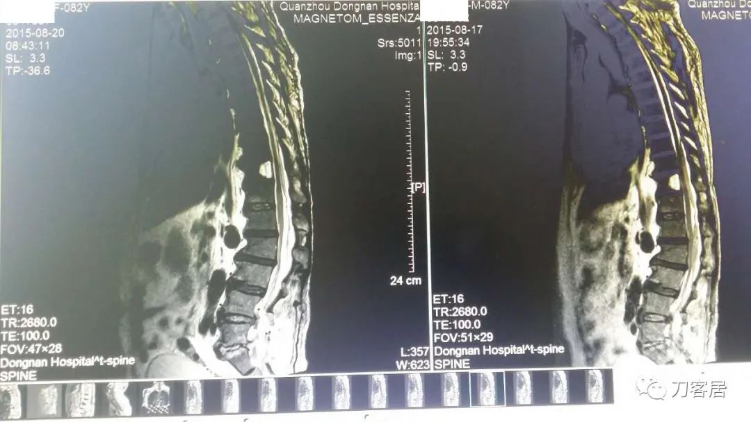 腰椎手术切掉棘突,腰突微创后出血肿