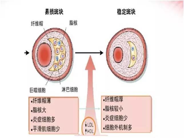 查颈动脉斑块挂什么科,颈动脉斑块的治疗方法