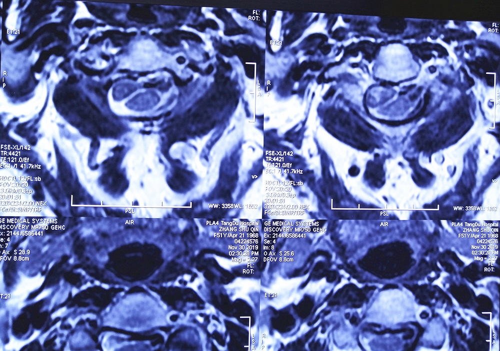 无缘无故手麻木伸不直,无缘无故两手发麻是什么情况