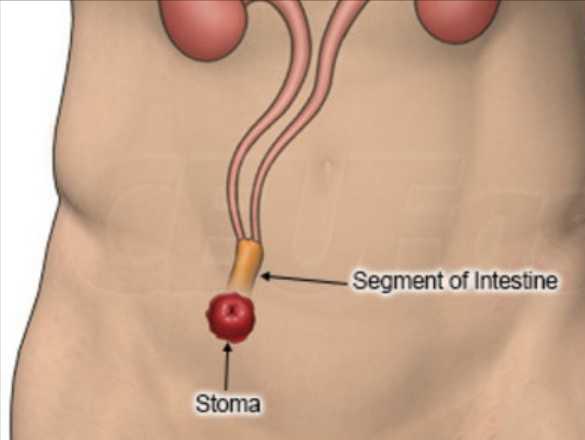 结肠癌术后，哪些人不能做结肠造口灌洗？