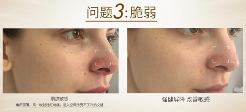 澳洲cemoy面霜真的好用吗,cemoy面霜修红测评