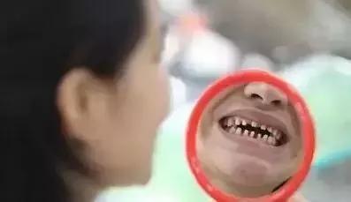 烤瓷牙可以解决牙齿不齐问题吗,烤瓷牙能修复吗