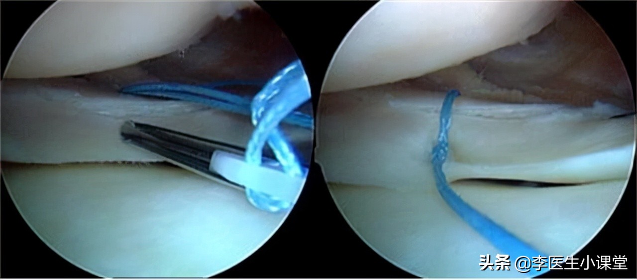 半月板损伤用什么样的膝关节支具,半月板损伤膝关节炎怎么治疗