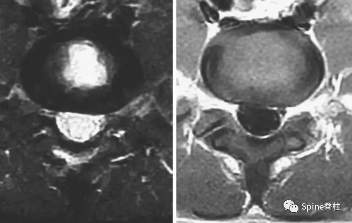 青少年一跑步就腰痛,青少年腰痛是什么原因引起的