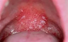 宝宝嘴里有白色的小点叫什么,一个月宝宝口腔上颚白色的是什么