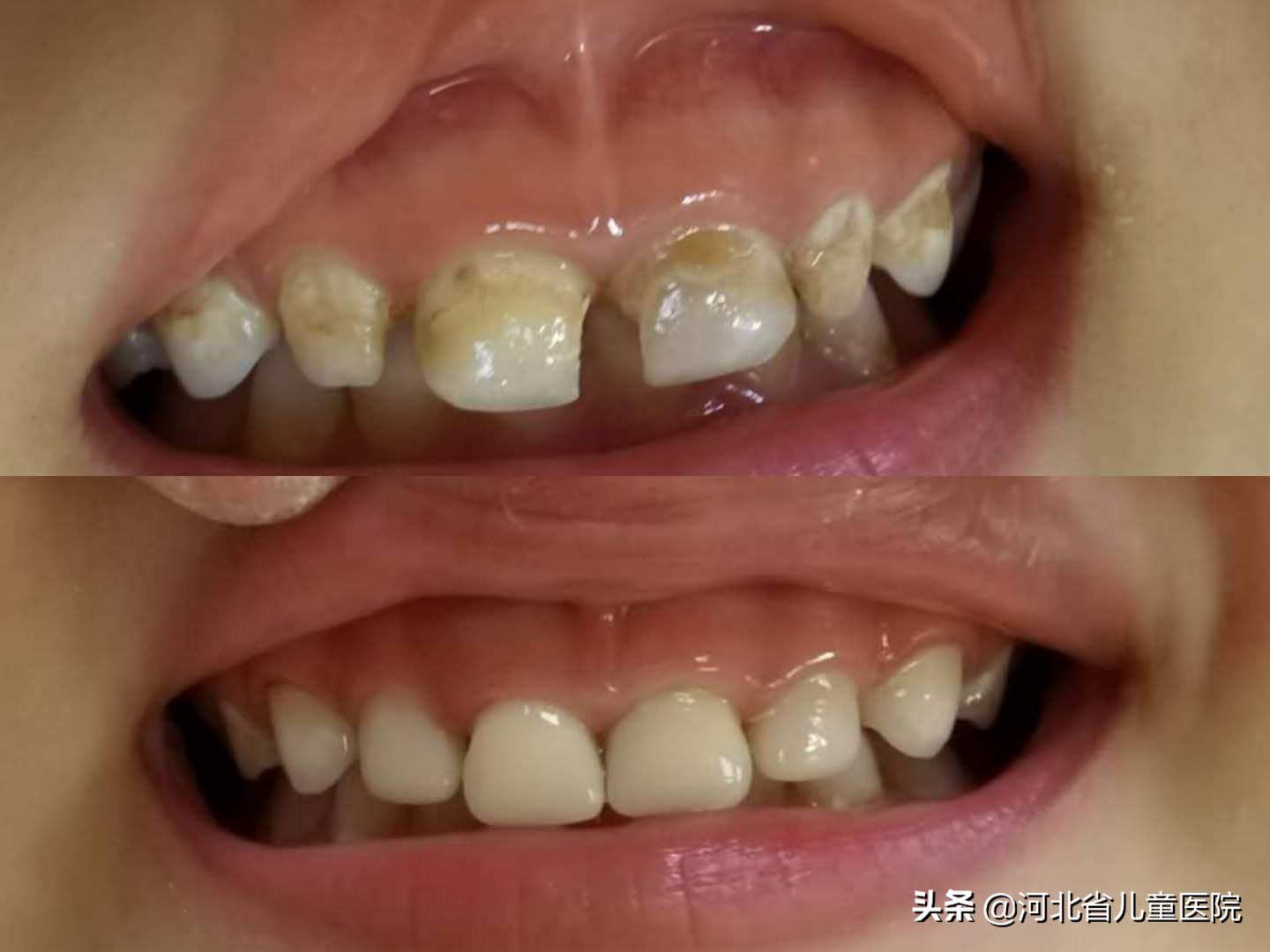 【注意】孩子牙齿龋坏、变黑怎么办？