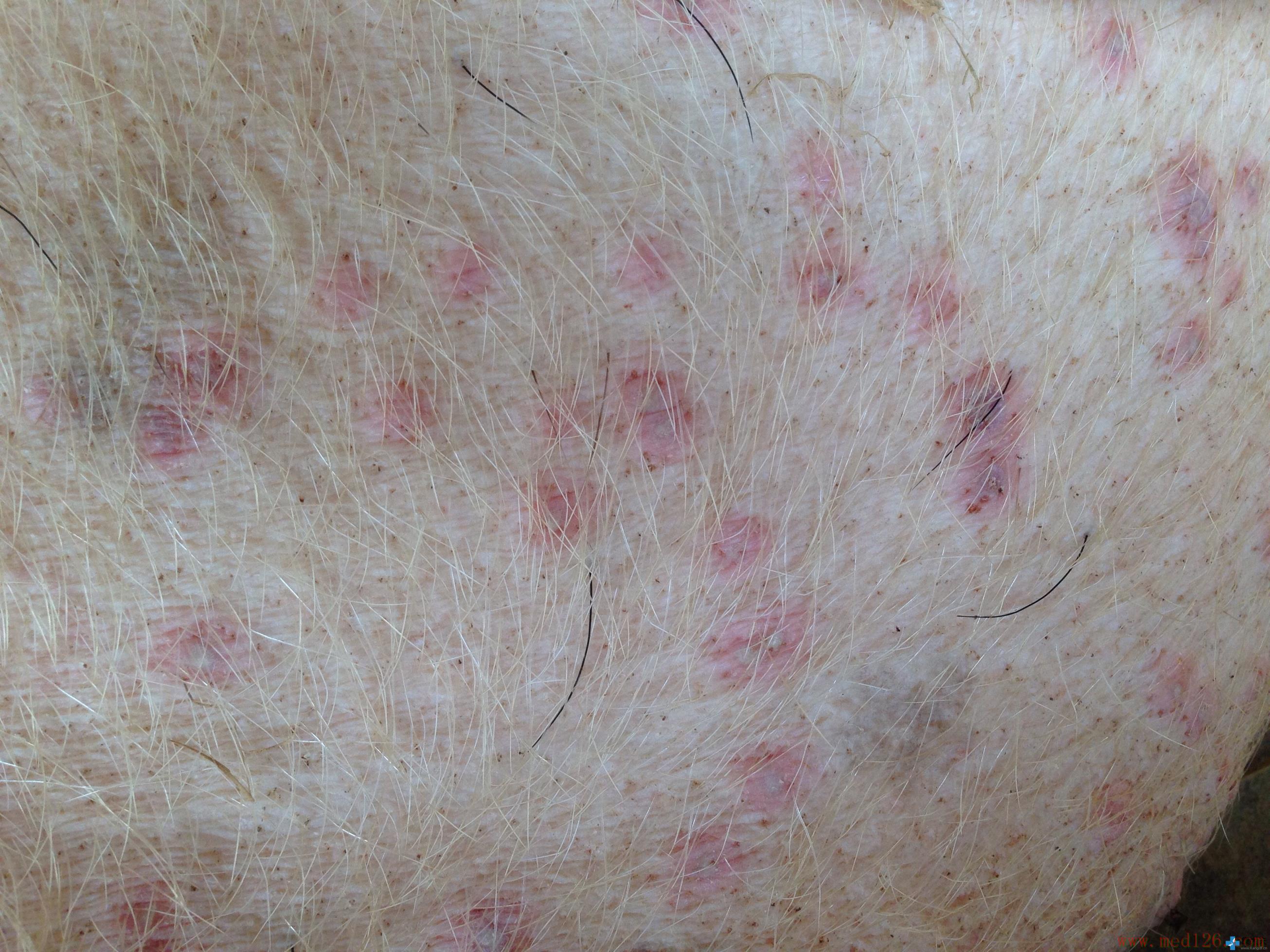 猪感染湿疹怎么治疗,猪感染疥螨怎么治疗