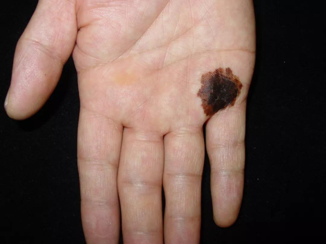 痣能点吗,我的痣凸起来会癌变吗