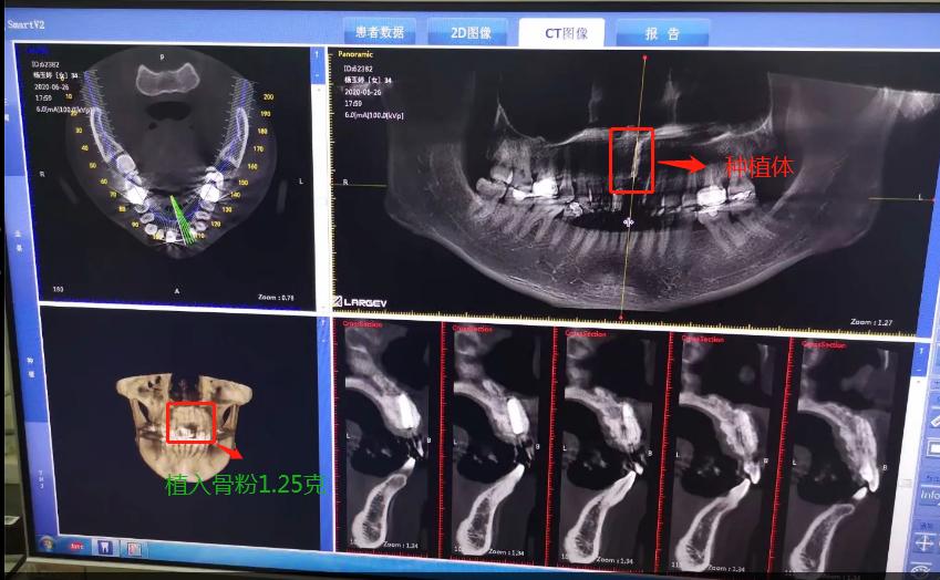 种门牙的亲身经历,种牙的心酸历程全文