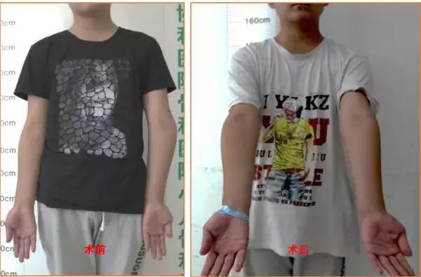 孩子胳膊向外弯怎么回事,小孩胳膊肘往内拐什么原因