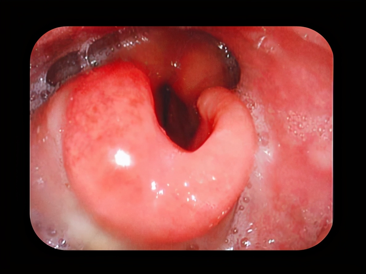 喉炎为什么导致声音嘶哑,喉炎所致呼吸困难