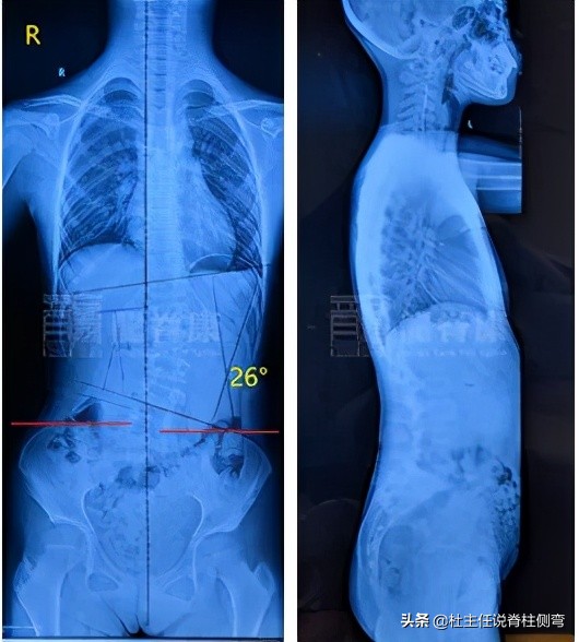 26岁长短腿脊柱侧弯可以矫正吗,脊柱侧弯会怎么治疗