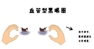 没有熬夜却有黑眼圈怎么消除,没熬夜的黑眼圈怎么去除