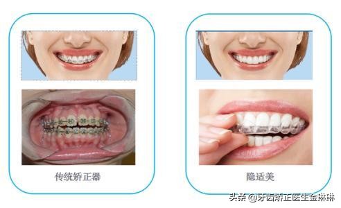 门牙不齐牙齿矫正一般多少钱,保定门牙有缝矫正需要多少钱