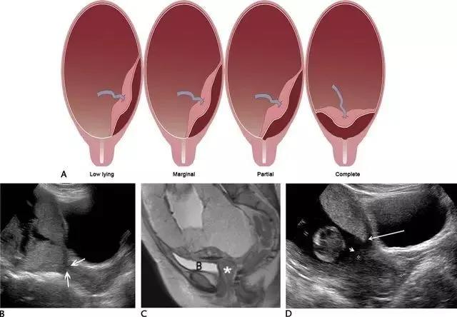 临床上最常见的异常胎盘,前置胎盘和低置胎盘超声