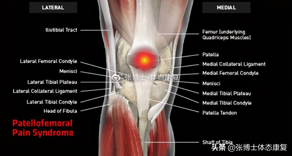 运动康复膝关节疼痛解决,下髌骨关节疼痛综合征