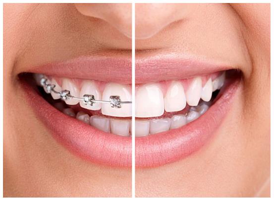 下牙不整齐如何自动矫正不戴牙套,半口牙矫正下排牙缝大