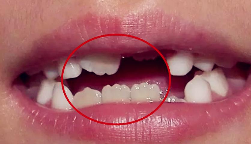 为什么乳牙好换牙就不好了,为什么现在的孩子换的门牙特别大